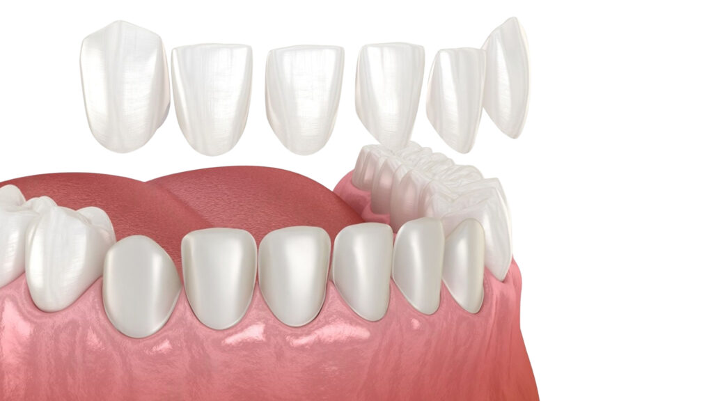 Porselen Kaplamalar ve Kronlar: Karşılaştırma: Farklılıklar, Benzerlikler ve Maliyet · Livera Dental Clinic Florya İstanbul