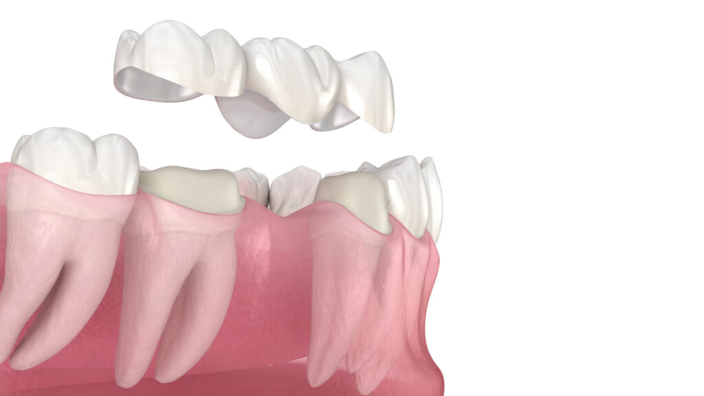Diş Kaplaması Türleri ve Fiyatları · Livera Dental Clinic Florya İstanbul