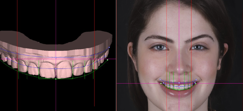 Estetik Diş Hekimliğinde En Popüler 5 Gülüş Tasarımı Uygulaması · Livera Dental Clinic Florya İstanbul
