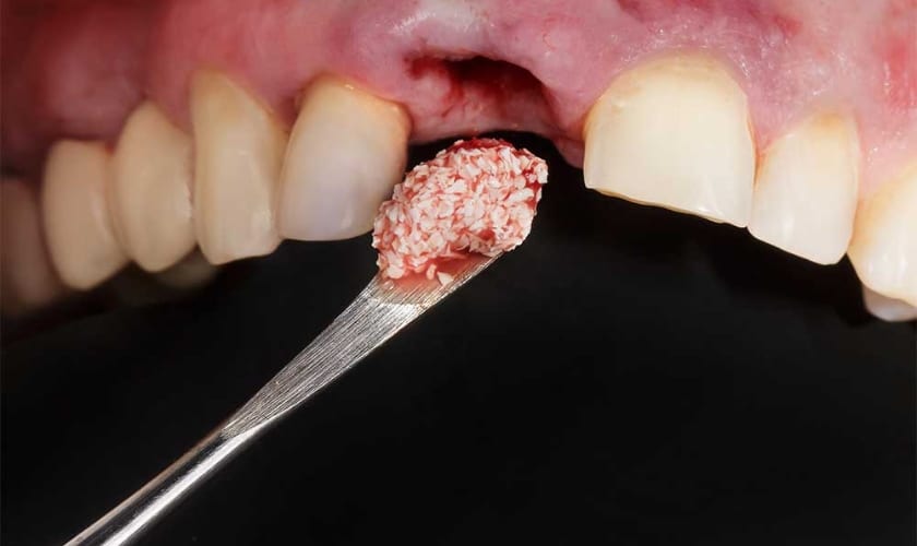 How Long After Bone Grafting Can I Get a Dental Implant? · Livera Dental Clinic Florya Istanbul