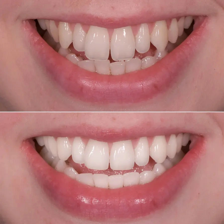 teeth shaping What is Teeth Shaping? How Is It Performed? · Livera Dental Clinic Florya Istanbul