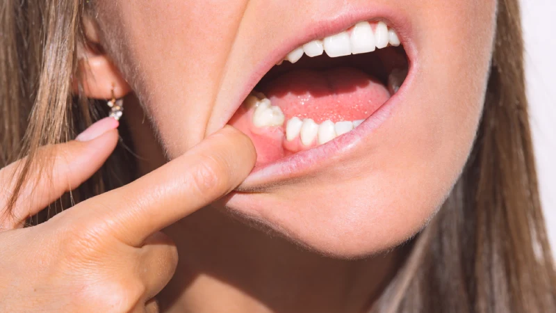 Diş Yutulursa Bir Şey Olur Mu? Zararları ve Yapılması Gerekenler · Livera Dental Clinic Florya İstanbul