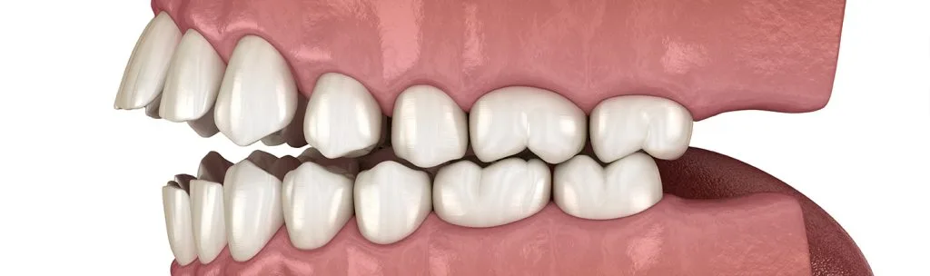 Toothlessness: Causes & Treatment Methods · Livera Dental Clinic Florya Istanbul