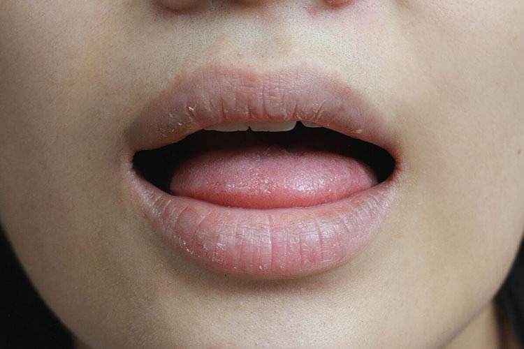 Что вызывает сухость во рту? Научный взгляд на дефицит слюны · Livera Dental Clinic Флория Стамбул
