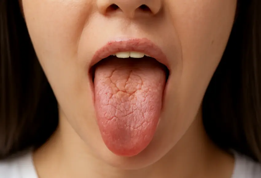 Что вызывает сухость во рту? Научный взгляд на дефицит слюны · Livera Dental Clinic Флория Стамбул