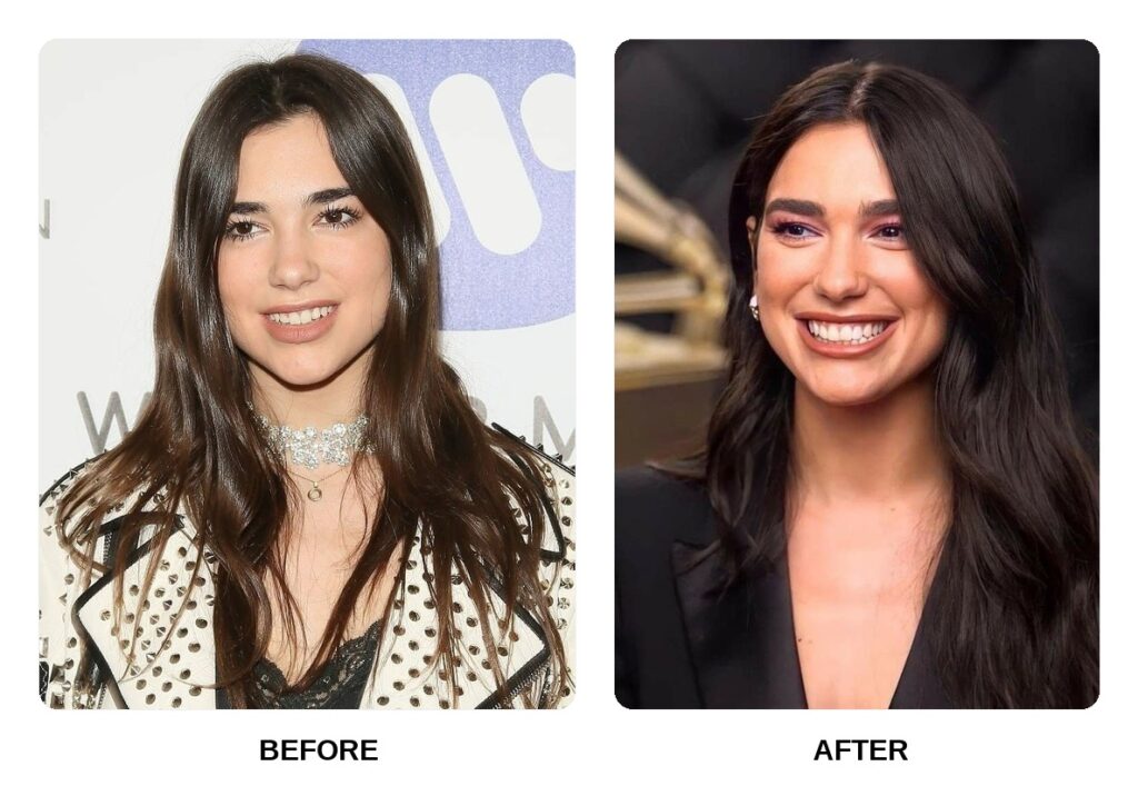 Dua Lipa Teeth: A Cultural Spark Turning Into a Modern Aesthetic Fascination · Livera Dental Clinic Florya Istanbul