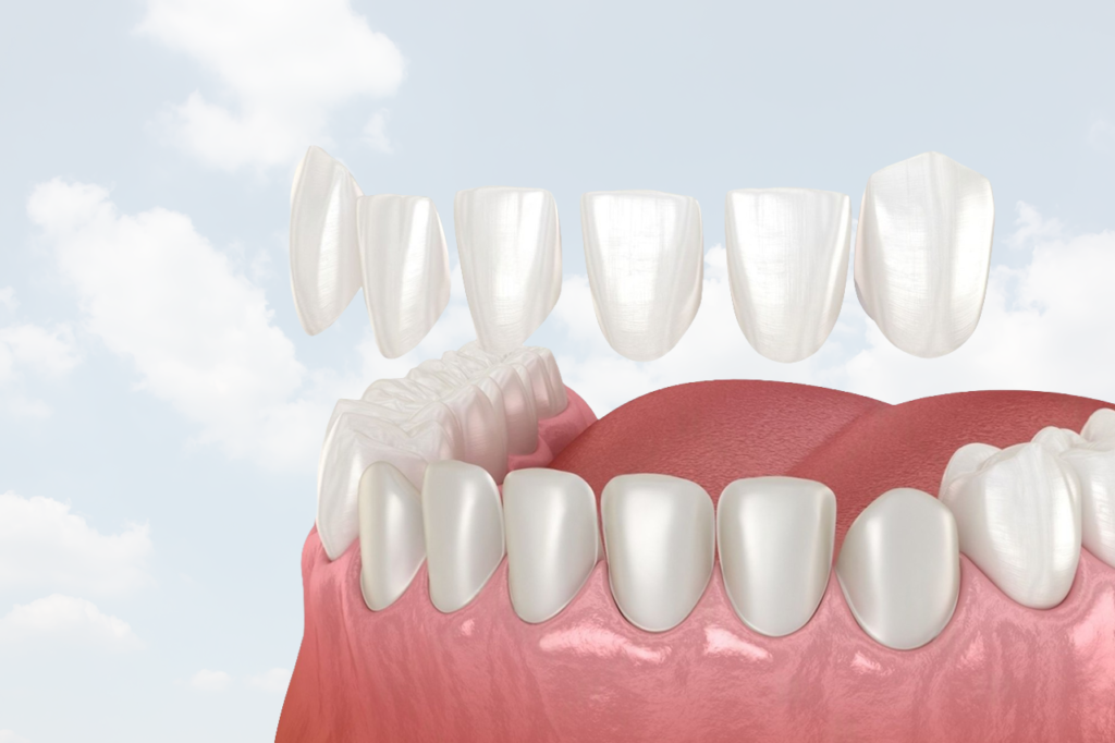 Achieve a Stunning Smile with E-Max Crown · Livera Dental Clinic Florya Istanbul