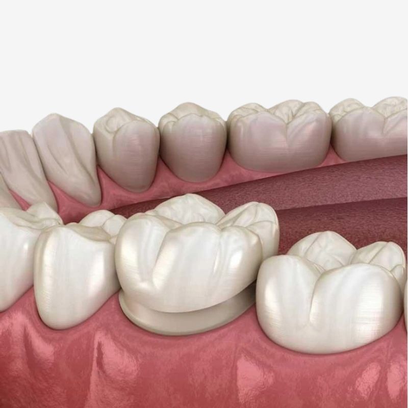 Are Veneers Permanent? How Long Do They Last? · Livera Dental Clinic Florya Istanbul
