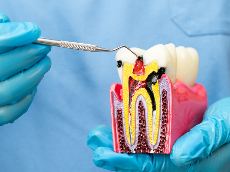 Endodontik Tedavi Hassasiyet ve Özenle Açıklanıyor · Livera Dental Clinic Florya İstanbul