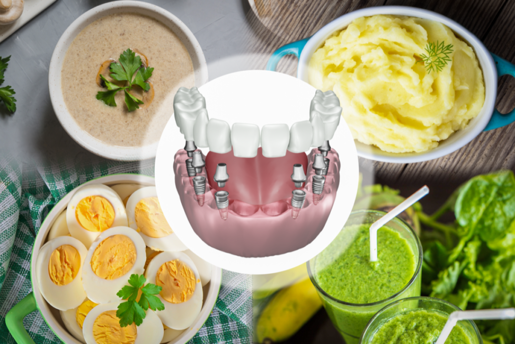 İmplant Ameliyatından Sonra Ne Yemelisiniz? · Livera Dental Clinic Florya İstanbul