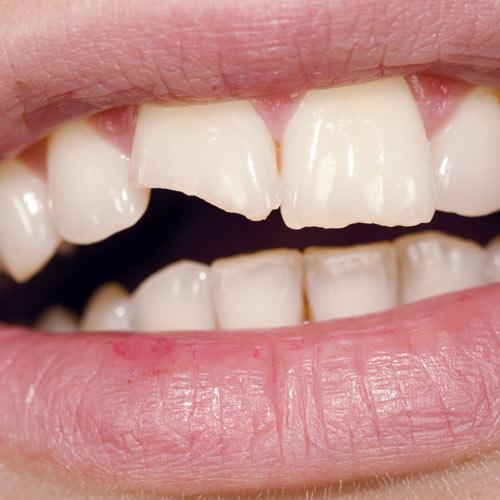 How to Repair a Broken Front Tooth: Modern Options, Materials, and Long Term Outcomes · Livera Dental Clinic Florya Istanbul