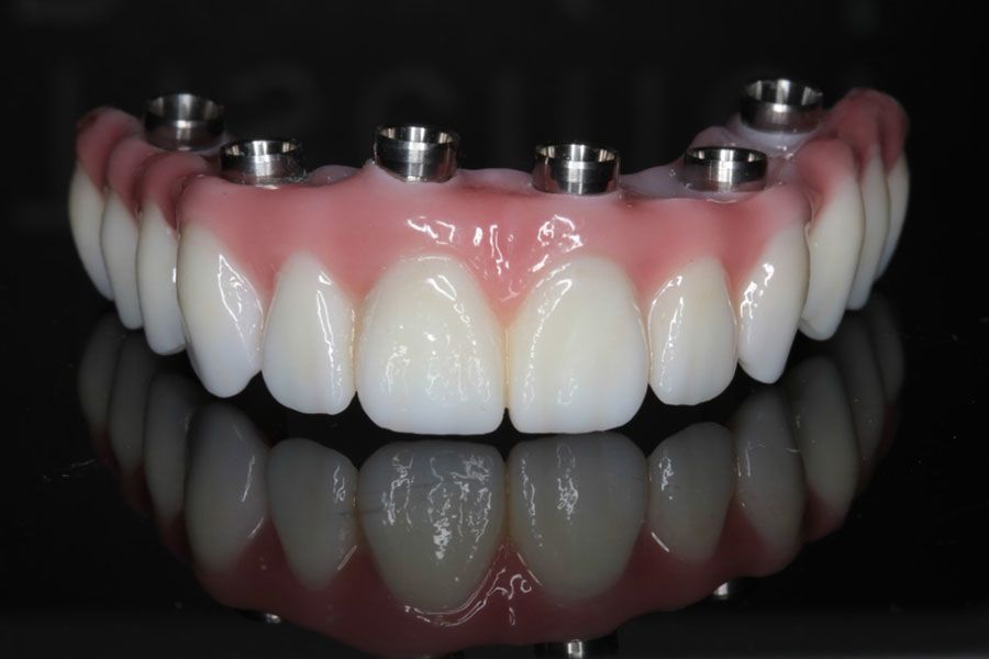 Tam Ağız Diş Rekonstrüksiyonu Rehberi · Livera Dental Clinic Florya İstanbul