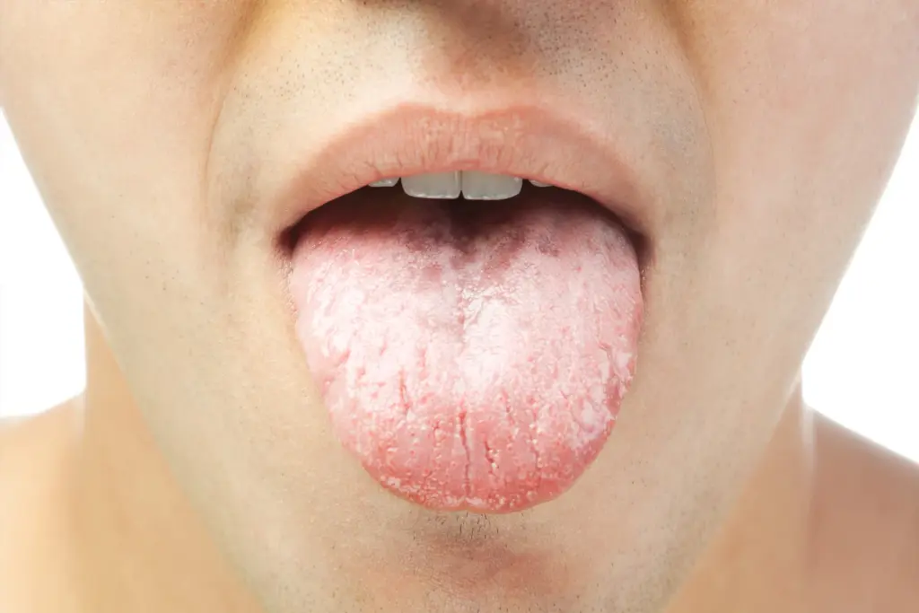 What Causes Dry Mouth and How Can It Be Treated? · Livera Dental Clinic Florya Istanbul