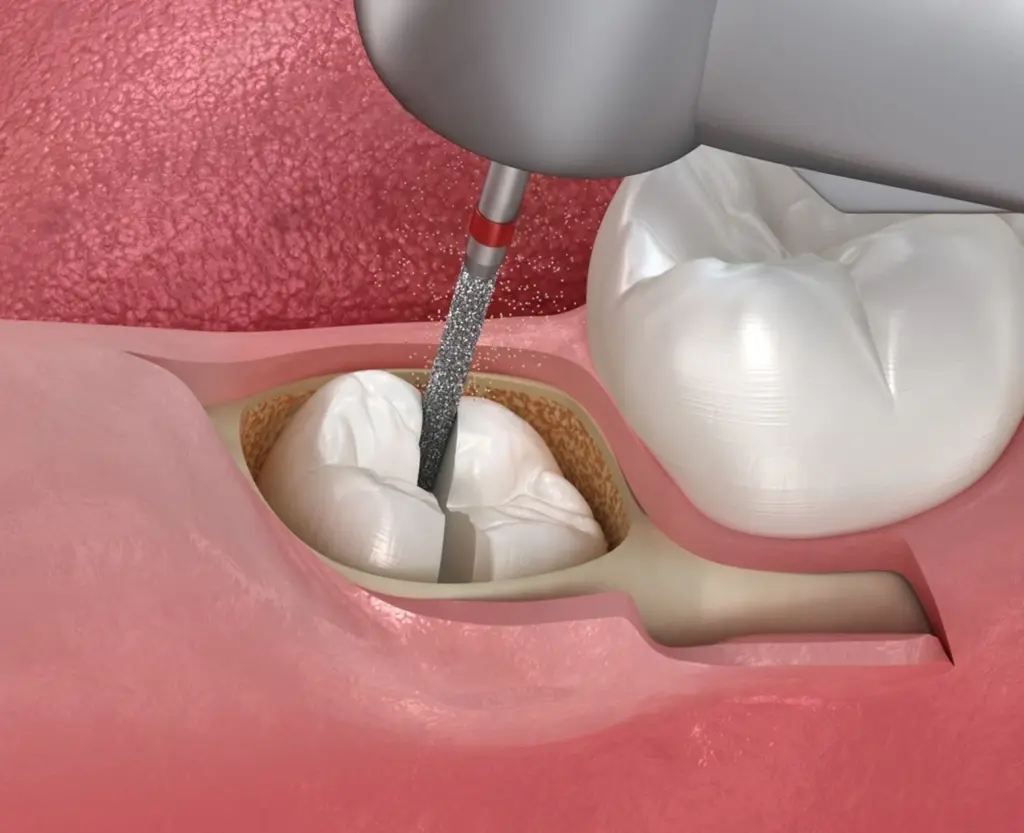 Wisdom Tooth Extraction: Recovery Process and Helpful Tips · Livera Dental Clinic Florya Istanbul