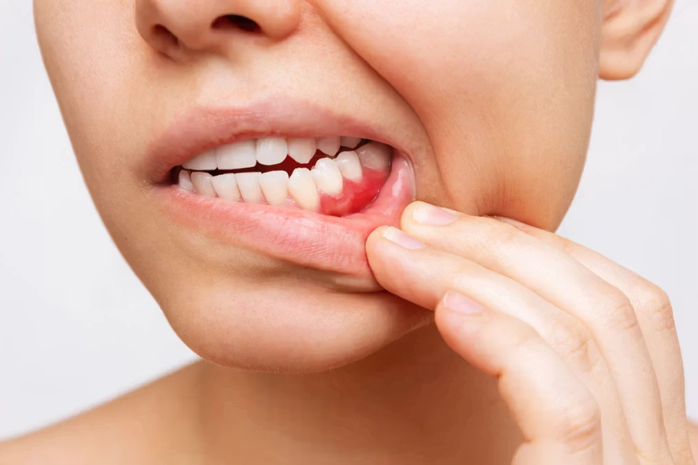 Diş eti hastalıkları nelerdir? · Livera Dental Clinic Florya İstanbul