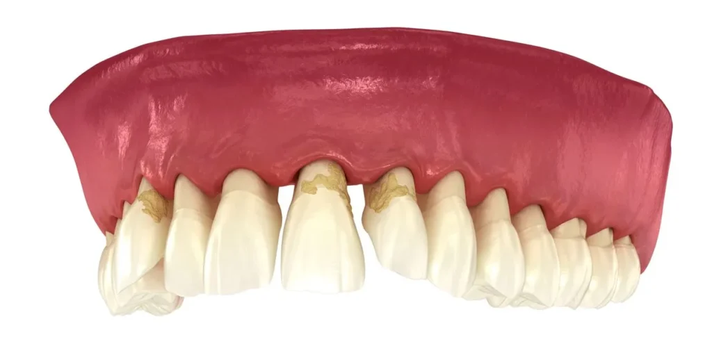 Gum Disease Что вызывает заболевания дёсен? · Livera Dental Clinic Флория Стамбул