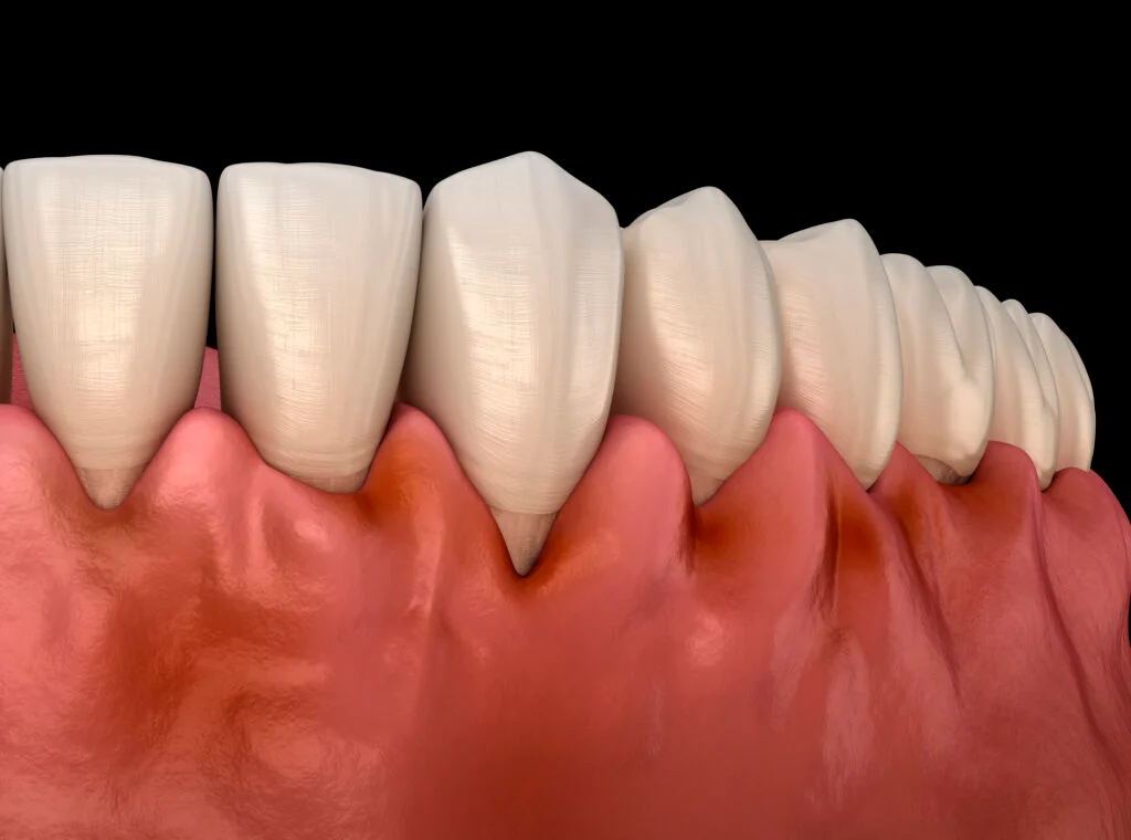 Diş Eti Çekilmesi: Tedavi İçin Çok Mu Geç? · Livera Dental Clinic Florya İstanbul