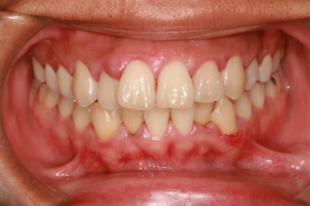 Diş Eti Çekilmesi: Tedavi İçin Çok Mu Geç? · Livera Dental Clinic Florya İstanbul