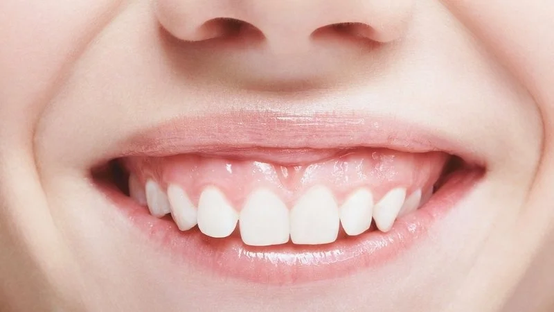 gummy smile Gummy Smile (Diş Eti Gülüşü): Nedenleri, Tedavi Yöntemleri ve Merak Edilenler · Livera Dental Clinic Florya İstanbul