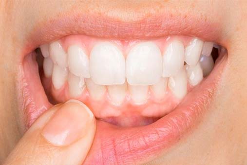 Diş Eti Çekilmesinin Dikkate Alınması Gereken 5 Aşaması · Livera Dental Clinic Florya İstanbul