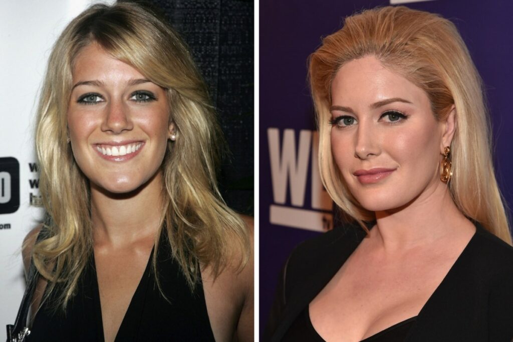 Heidi Montag Teeth Transformation · Livera Dental Clinic Florya Istanbul