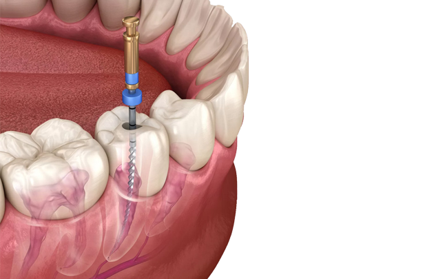 Diş Siniri Nasıl Alınır? · Livera Dental Clinic Florya İstanbul