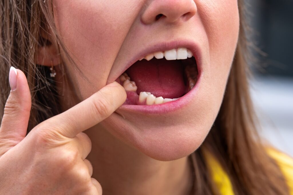 How Many Teeth Can Be Extracted at the Same Time? · Livera Dental Clinic Florya Istanbul