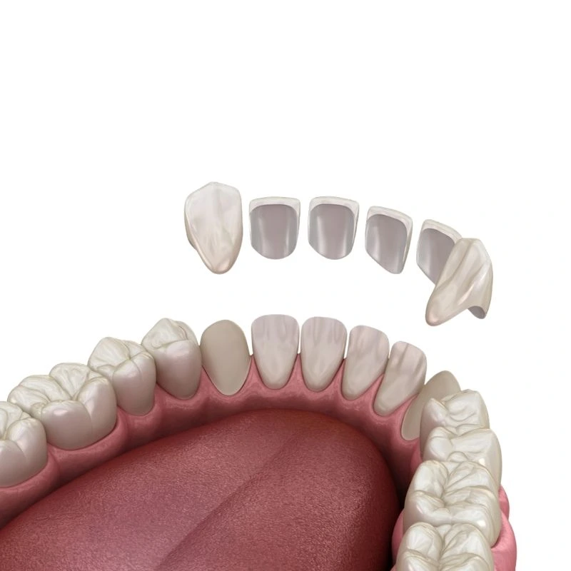 How Long Does It Take to Get a Dental Crown (Veneer) Fitted? · Livera Dental Clinic Florya Istanbul