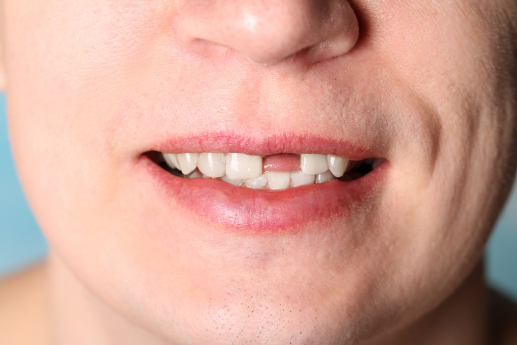 What Should Be Done About Loose Teeth? · Livera Dental Clinic Florya Istanbul