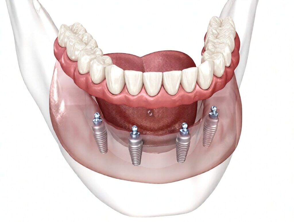 Can Dental Implants Be Placed in People with Bone Loss? · Livera Dental Clinic Florya Istanbul
