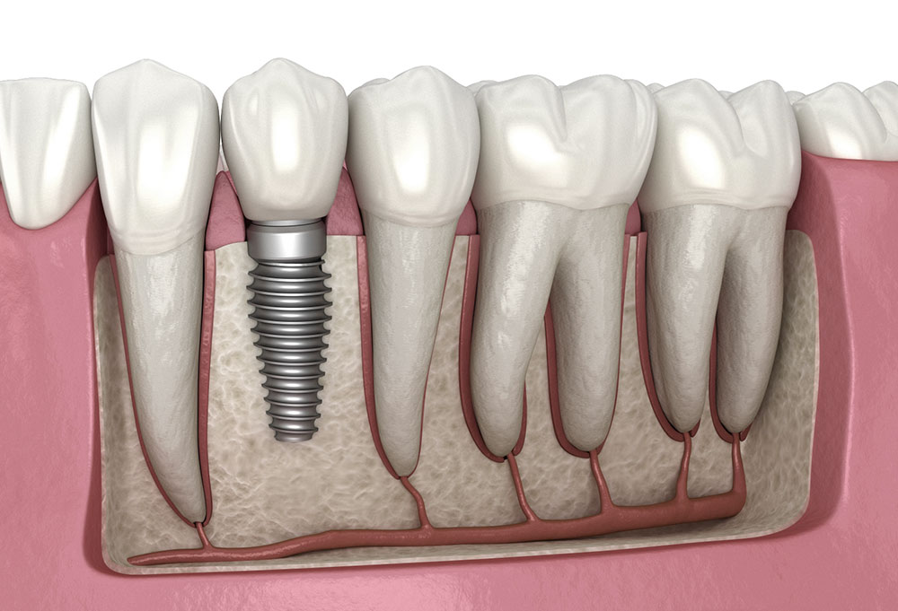 Необходим ли синус-лифт для дентальных имплантов? · Livera Dental Clinic Флория Стамбул