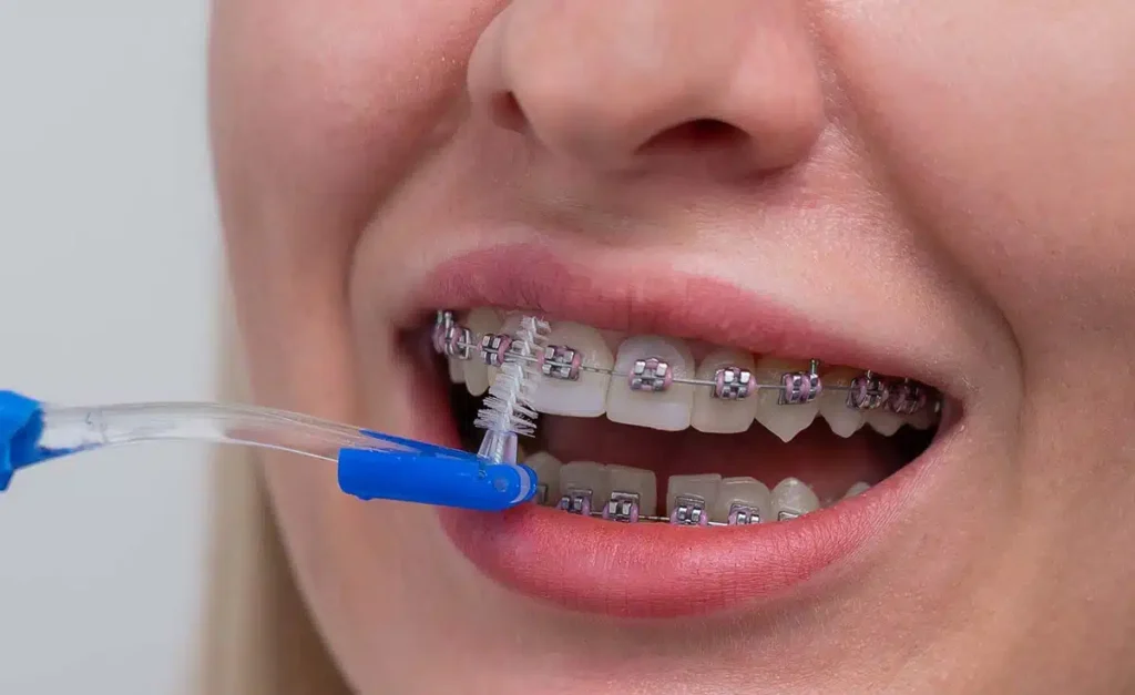Dental Caries and Cavities: Differences and Treatment Options · Livera Dental Clinic Florya Istanbul