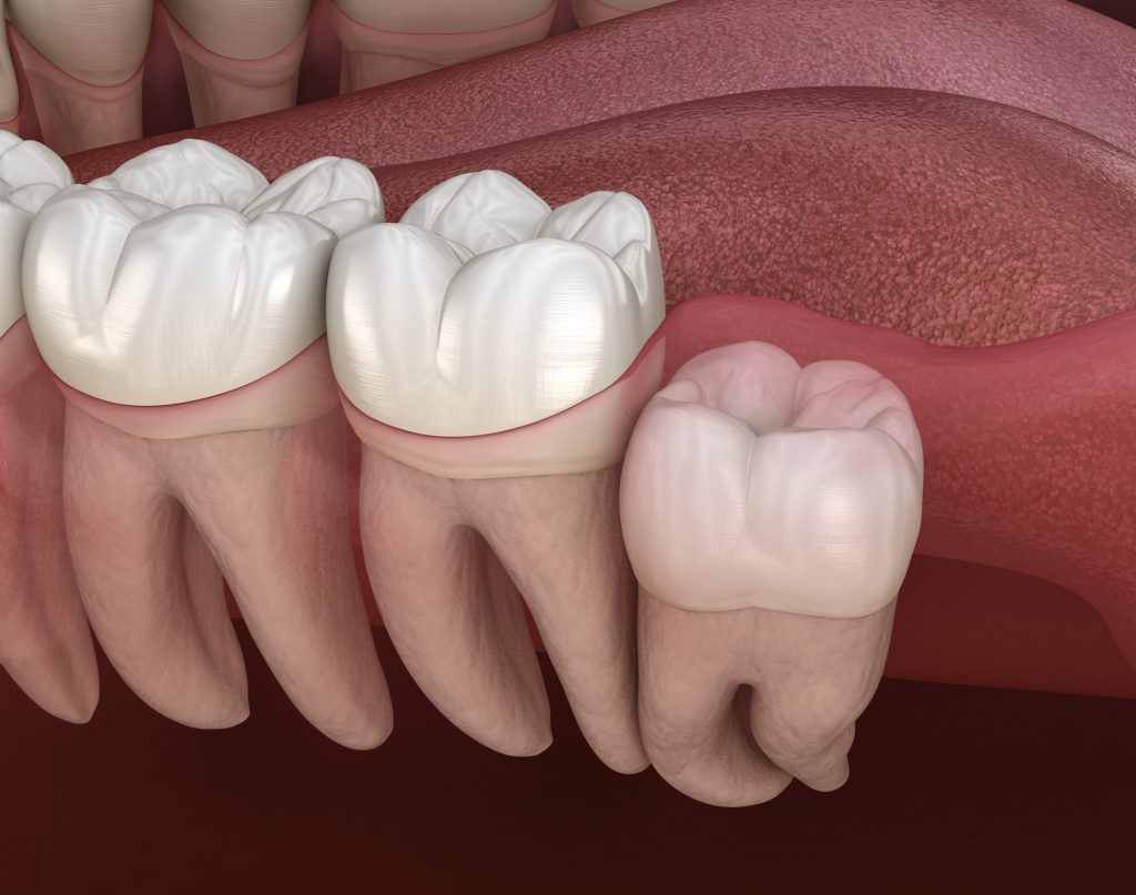 What Is an Impacted Tooth? How Is Impacted Tooth Surgery Performed? · Livera Dental Clinic Florya Istanbul