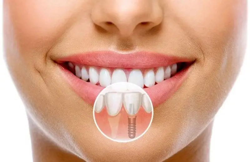 Recovery and Care Guide After Implant Treatment · Livera Dental Clinic Florya Istanbul