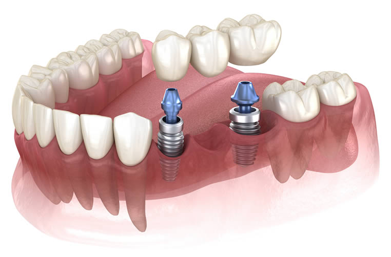 Can You Get a Dental Implant from the NHS? · Livera Dental Clinic Florya Istanbul