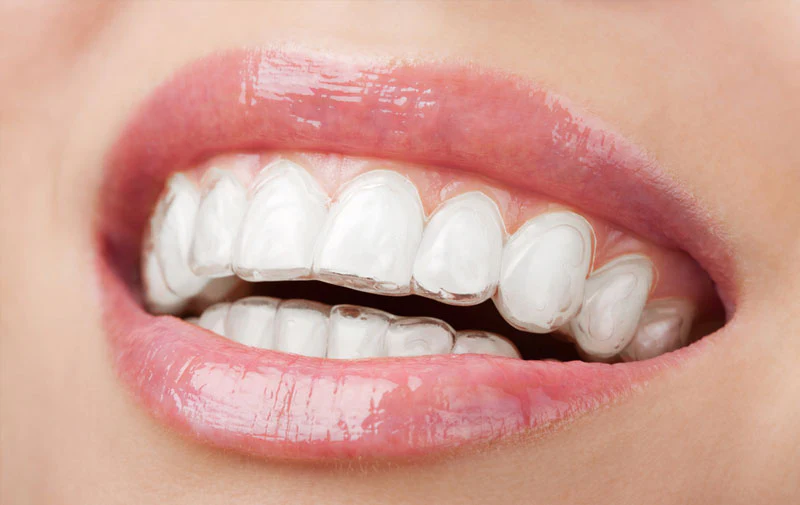 Overbite İçin Invisalign Tedavisi · Livera Dental Clinic Florya İstanbul