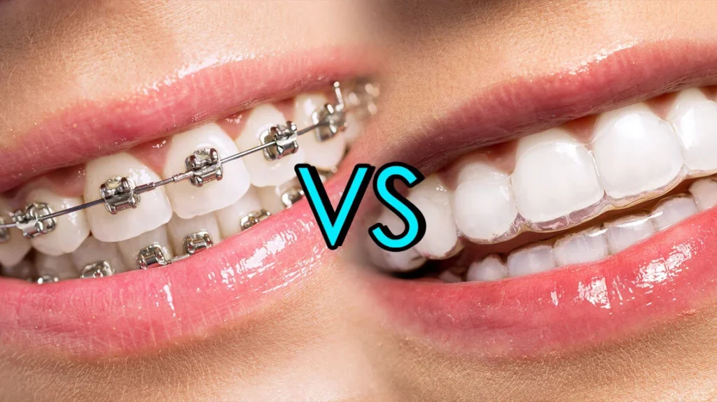 Braces or Clear Aligners: Which Option Suits You Best? · Livera Dental Clinic Florya Istanbul