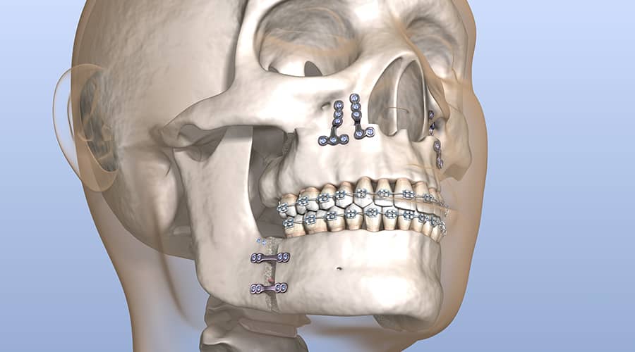 Improve Your Oral Health with Jaw Surgery · Livera Dental Clinic Florya Istanbul