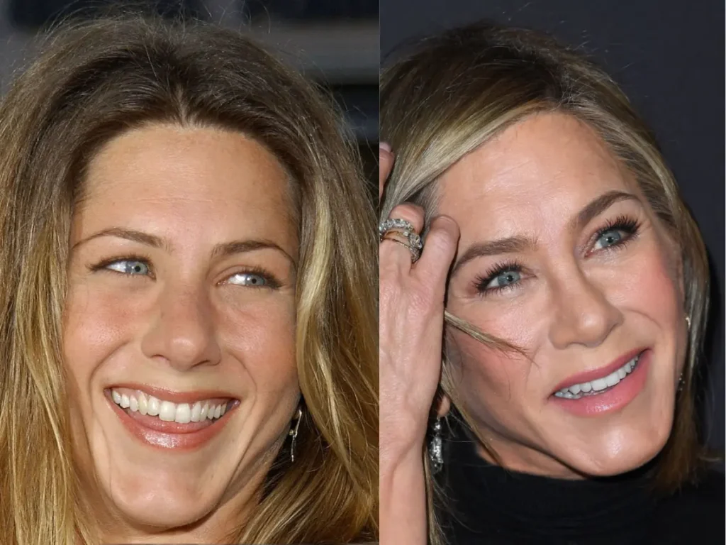 Jennifer Aniston Dişleri: İkonik Gülüşün Ardındaki Sır · Livera Dental Clinic Florya İstanbul