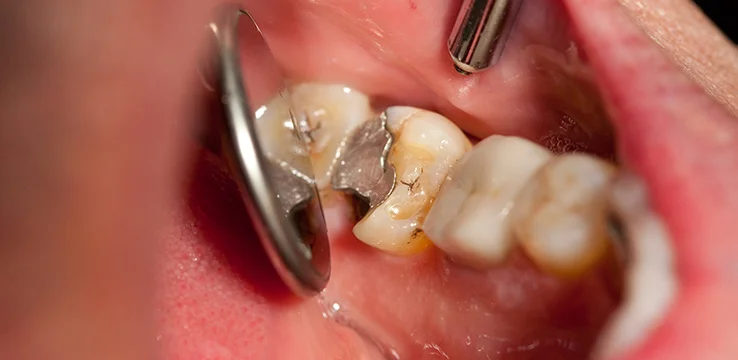 What is the Recovery Process After Root Canal Treatment? · Livera Dental Clinic Florya Istanbul