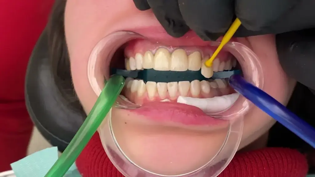 2026 Guide to Dental Veneer Prices · Livera Dental Clinic Florya Istanbul
