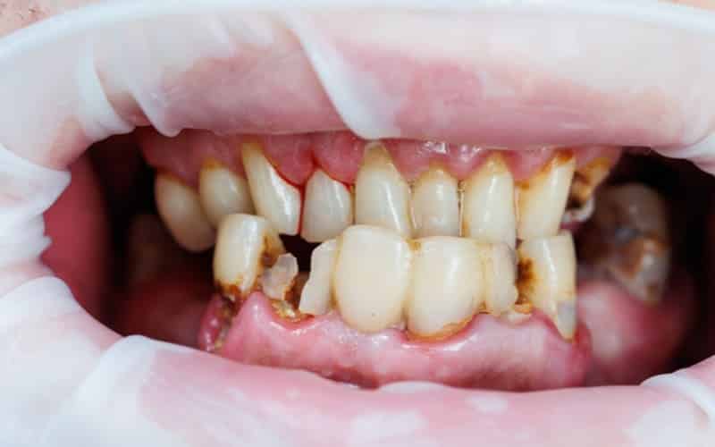 Malocclusion: Types, Causes, Expenses, and Costs · Livera Dental Clinic Florya Istanbul