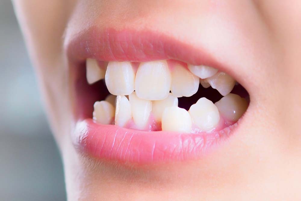 Malocclusion: Types, Causes, Expenses, and Costs · Livera Dental Clinic Florya Istanbul