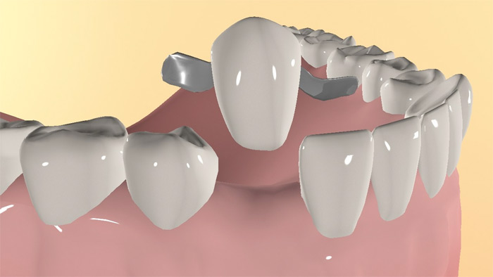 Maryland Köprüsü Nedir? Avantajları ve Dezavantajları · Livera Dental Clinic Florya İstanbul
