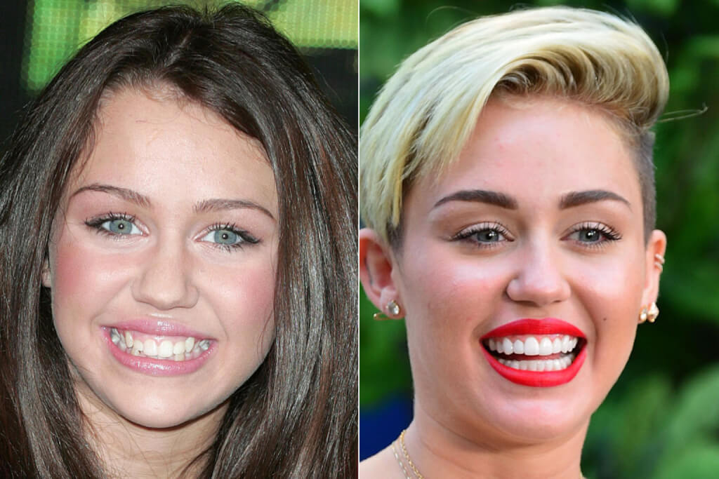 6 Celebrities Who Got Porcelain Veneers: Their Smile Transformations · Livera Dental Clinic Florya Istanbul