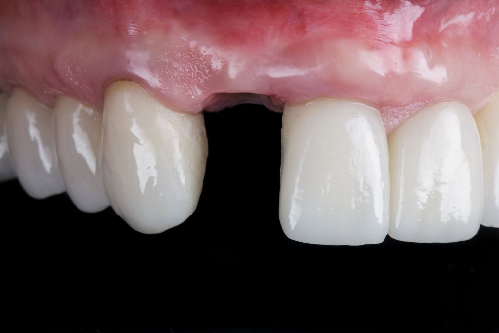 4 Causes of Tooth Loss and Ways to Understand Prevention · Livera Dental Clinic Florya Istanbul