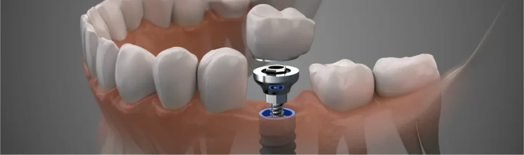 Nobel Implant: Pros, Cons, and Cost · Livera Dental Clinic Florya Istanbul