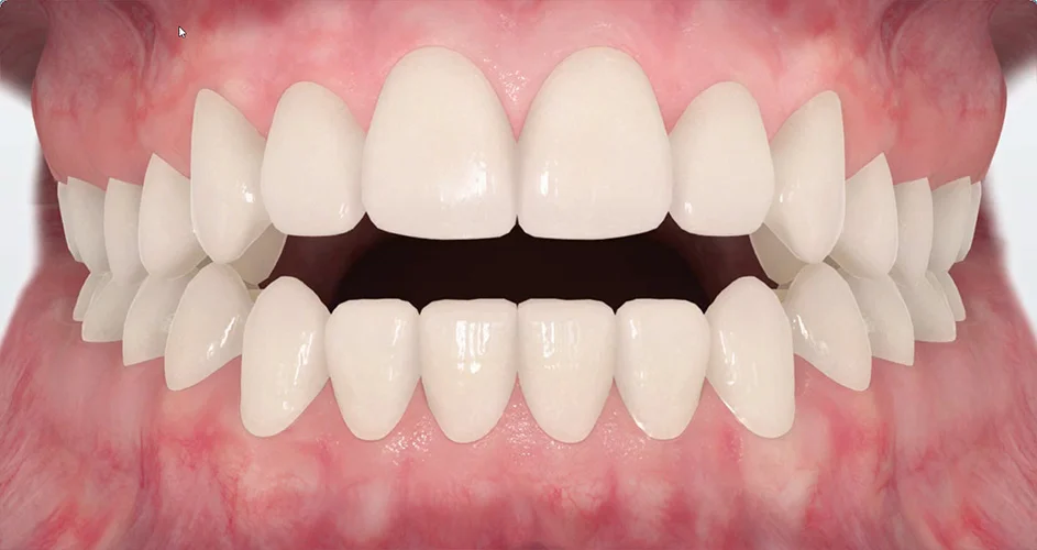 Open Bite: Understanding Causes and Treatment Costs · Livera Dental Clinic Florya Istanbul