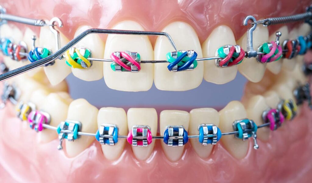 Preparing Your Child for Orthodontics Treatment · Livera Dental Clinic Florya Istanbul