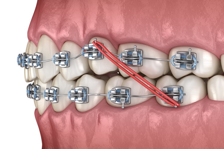 Preparing Your Child for Orthodontics Treatment · Livera Dental Clinic Florya Istanbul